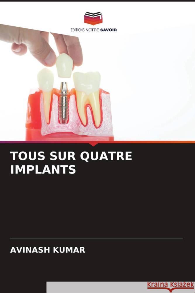 TOUS SUR QUATRE IMPLANTS Kumar, Avinash 9786208300456