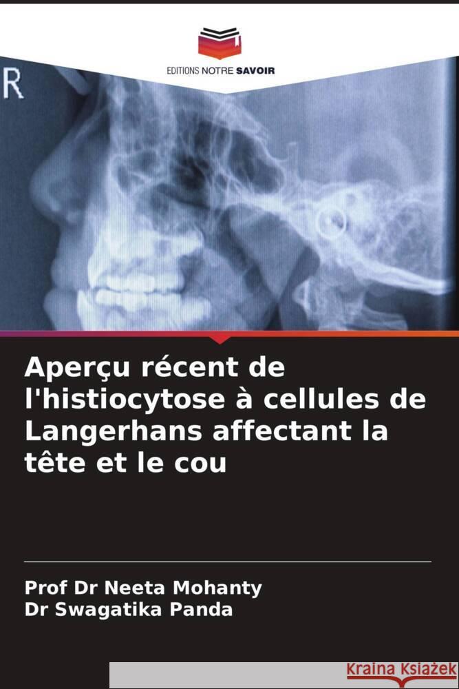 Aperçu récent de l'histiocytose à cellules de Langerhans affectant la tête et le cou Mohanty, Prof Dr Neeta, Panda, Dr Swagatika 9786208326920