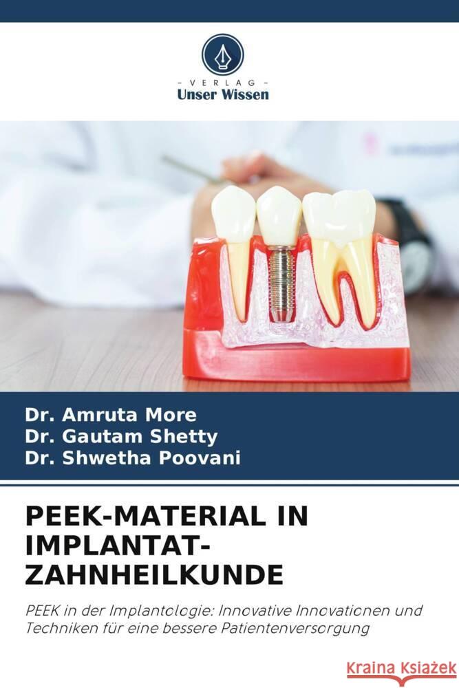 Peek-Material in Implantat-Zahnheilkunde Amruta More Gautam Shetty Shwetha Poovani 9786208329297