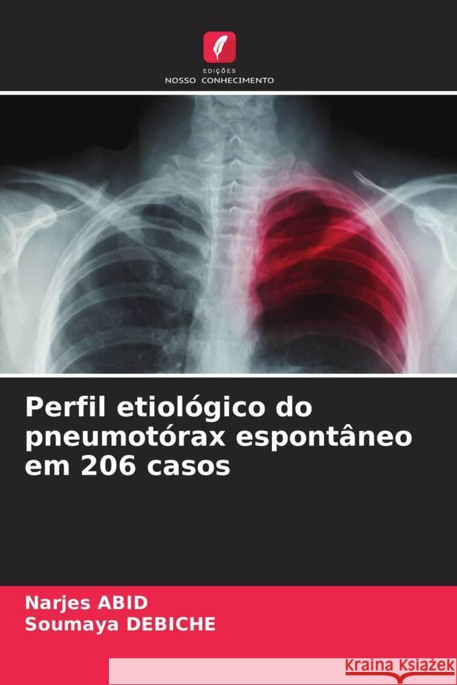 Perfil etiológico do pneumotórax espontâneo em 206 casos Abid, Narjes, Debiche, Soumaya 9786208382537