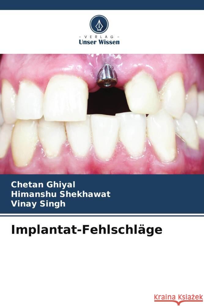 Implantat-Fehlschläge Ghiyal, Chetan, Shekhawat, Himanshu, Singh, Vinay 9786208387105 Verlag Unser Wissen