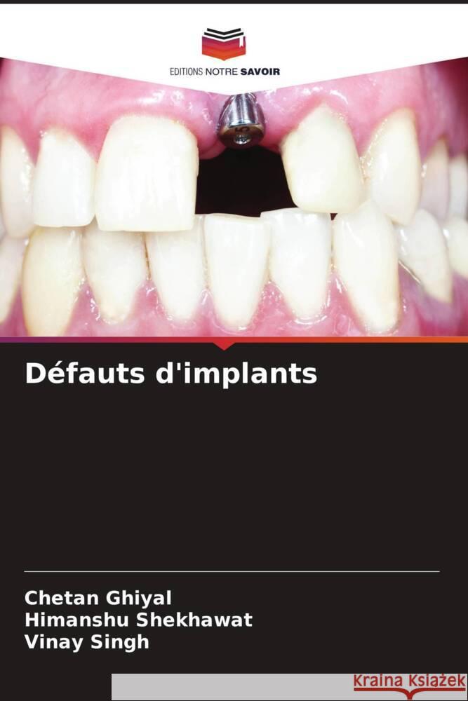 Défauts d'implants Ghiyal, Chetan, Shekhawat, Himanshu, Singh, Vinay 9786208387181 Editions Notre Savoir