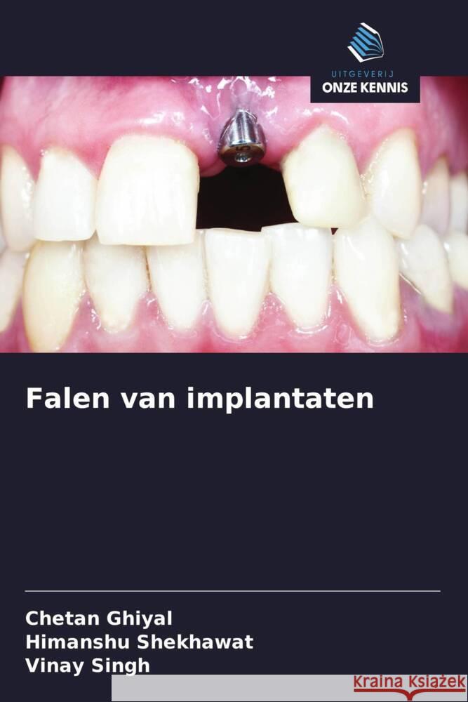 Falen van implantaten Ghiyal, Chetan, Shekhawat, Himanshu, Singh, Vinay 9786208387204 Uitgeverij Onze Kennis