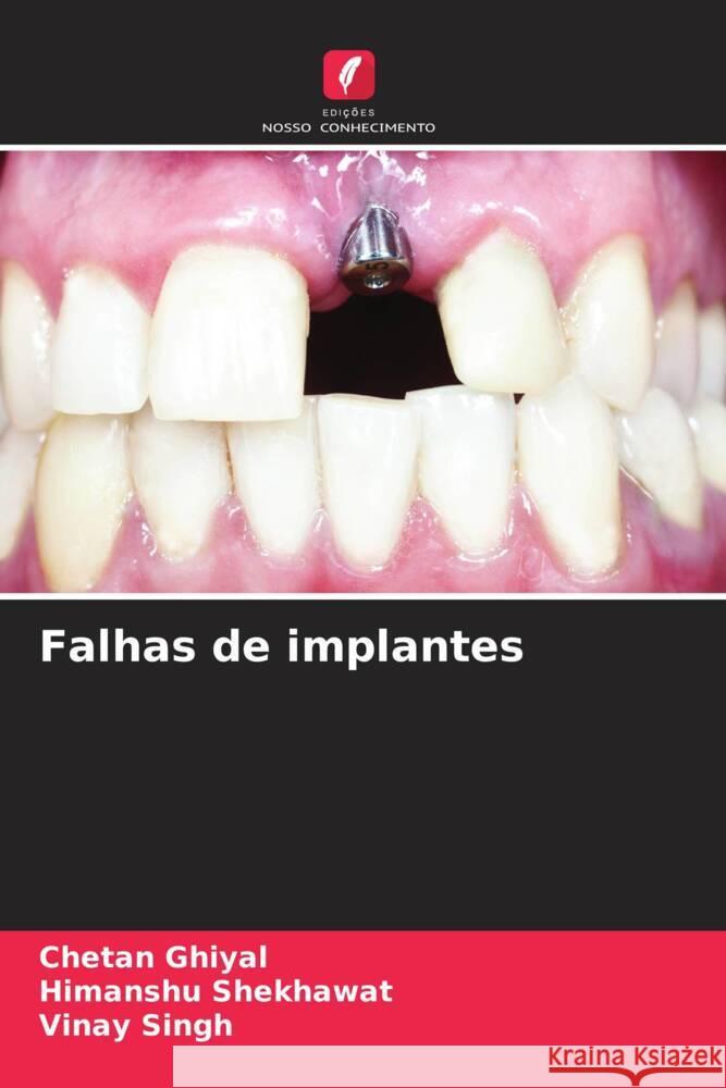 Falhas de implantes Ghiyal, Chetan, Shekhawat, Himanshu, Singh, Vinay 9786208387211 Edições Nosso Conhecimento