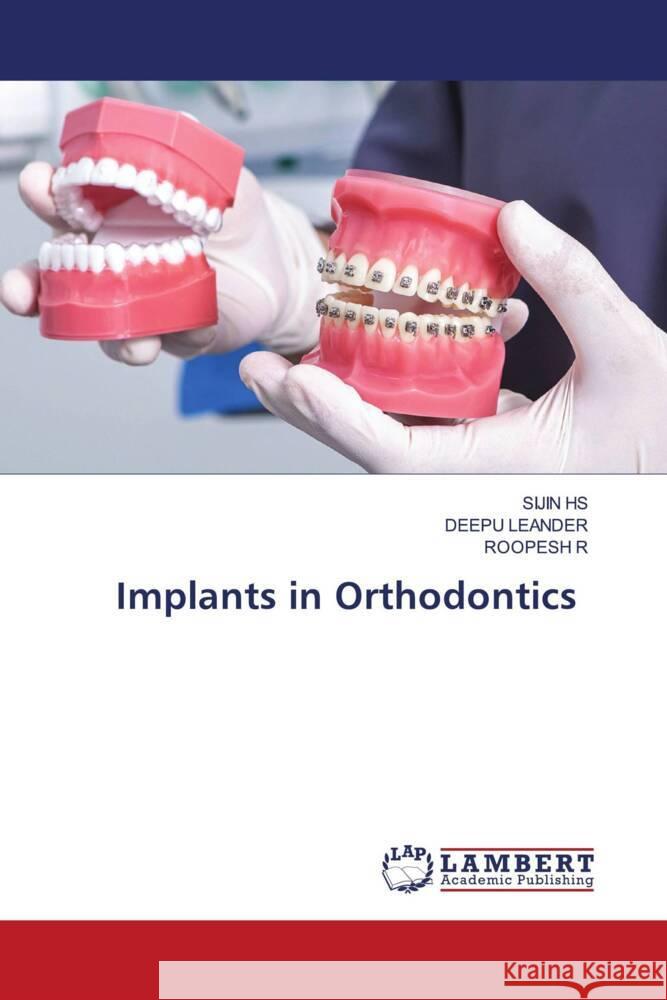 Implants in Orthodontics HS, SIJIN, LEANDER, DEEPU, R, ROOPESH 9786208428327 LAP Lambert Academic Publishing