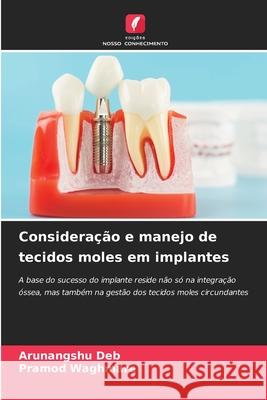 Consideração e manejo de tecidos moles em implantes Deb, Arunangshu, Waghmare, Pramod 9786208470036