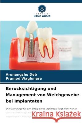 Berücksichtigung und Management von Weichgewebe bei Implantaten Deb, Arunangshu, Waghmare, Pramod 9786208472597