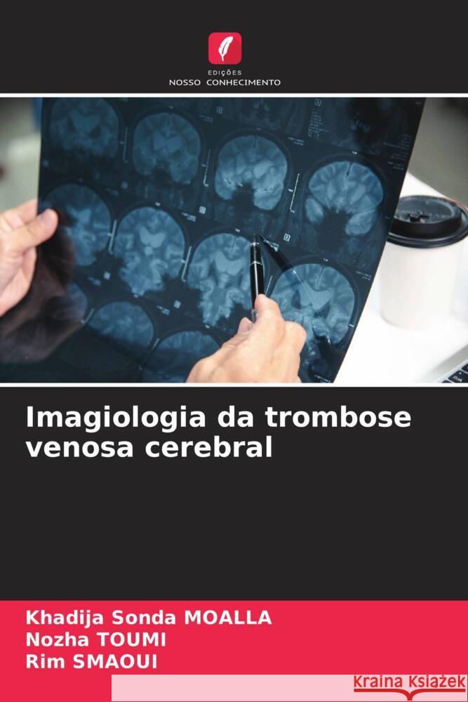 Imagiologia da trombose venosa cerebral MOALLA, Khadija Sonda, Toumi, Nozha, SMAOUI, Rim 9786208531614