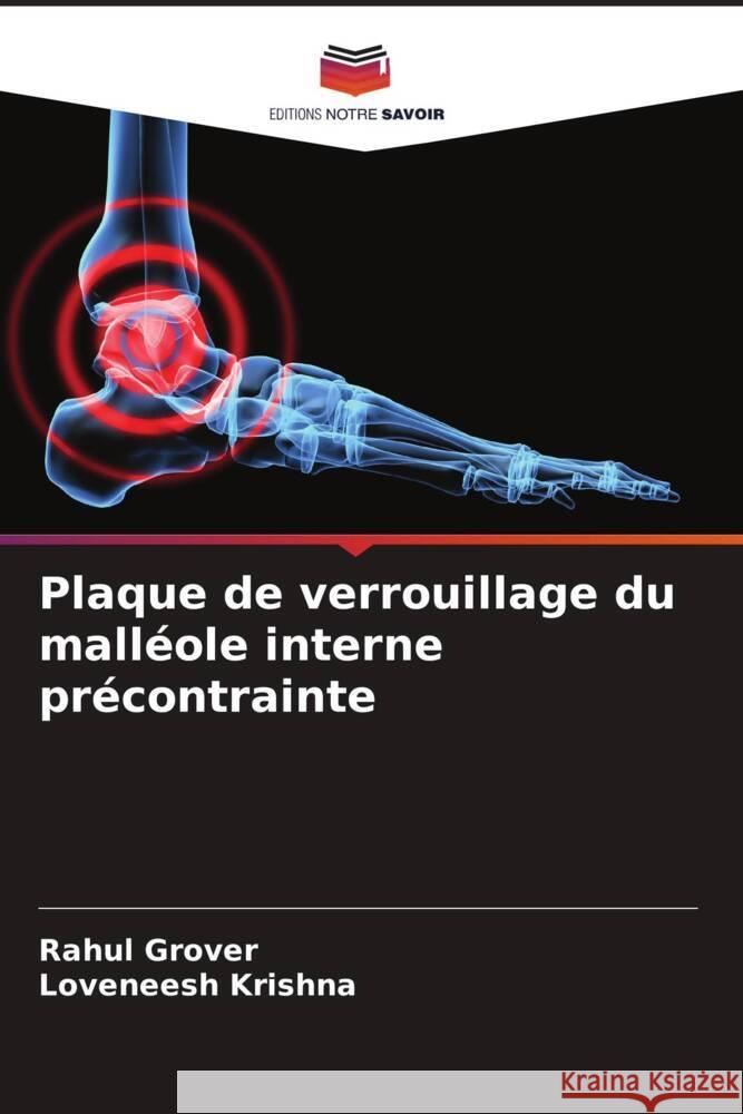 Plaque de verrouillage du malléole interne précontrainte Grover, Rahul, Krishna, Loveneesh 9786208551933