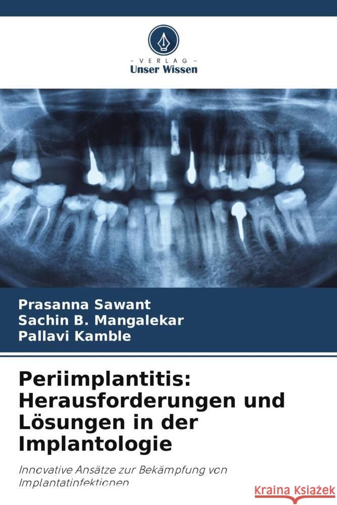 Periimplantitis: Herausforderungen und L?sungen in der Implantologie Prasanna Sawant Sachin B. Mangalekar Pallavi Kamble 9786208611545