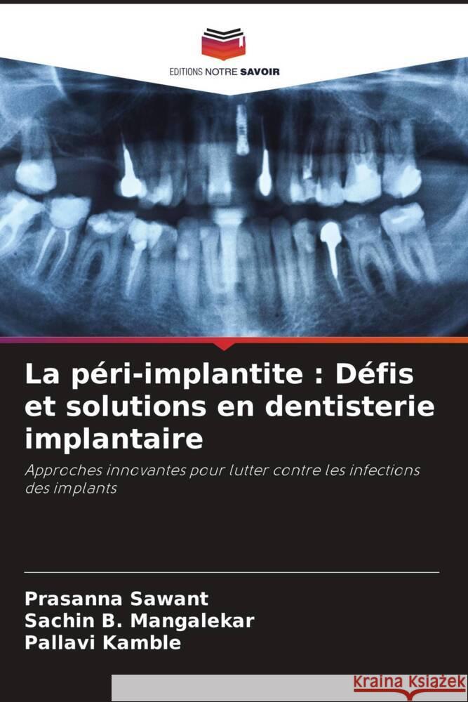 La p?ri-implantite: D?fis et solutions en dentisterie implantaire Prasanna Sawant Sachin B. Mangalekar Pallavi Kamble 9786208611569