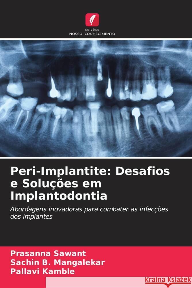 Peri-Implantite: Desafios e Solu??es em Implantodontia Prasanna Sawant Sachin B. Mangalekar Pallavi Kamble 9786208611583