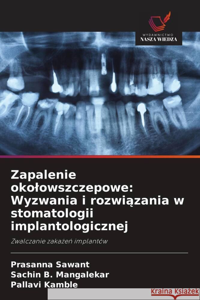 Zapalenie okolowszczepowe: Wyzwania i rozwiązania w stomatologii implantologicznej Prasanna Sawant Sachin B. Mangalekar Pallavi Kamble 9786208611590