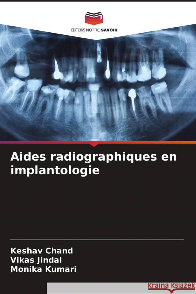 Aides radiographiques en implantologie Chand, Keshav, Jindal, Vikas, Kumari, Monika 9786208618124