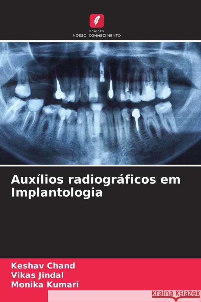 Auxílios radiográficos em Implantologia Chand, Keshav, Jindal, Vikas, Kumari, Monika 9786208618148