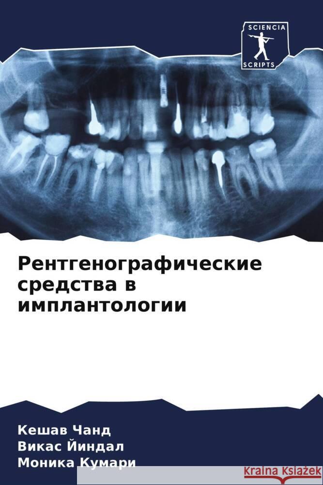 Rentgenograficheskie sredstwa w implantologii Chand, Keshaw, Jindal, Vikas, Kumari, Monika 9786208618162