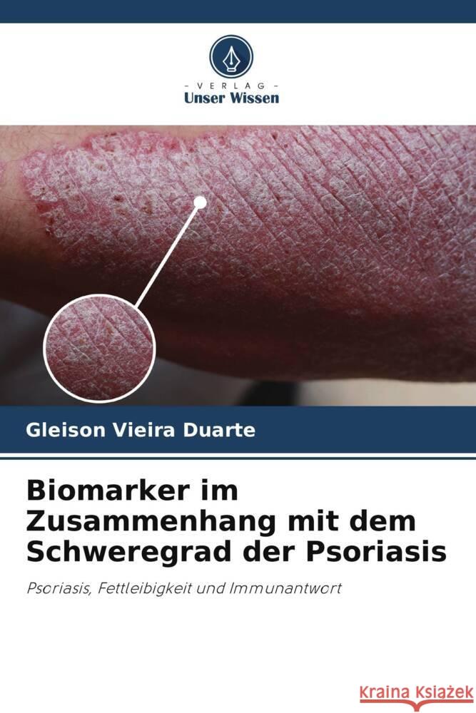 Biomarker im Zusammenhang mit dem Schweregrad der Psoriasis Vieira Duarte, Gleison 9786208668310