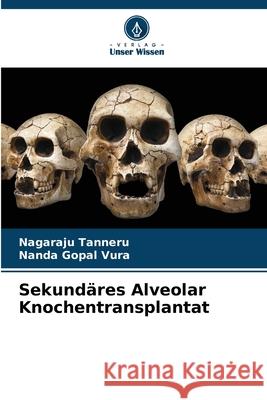 Sekundäres Alveolar Knochentransplantat Tanneru, Nagaraju, Vura, Nanda Gopal 9786208724733 Verlag Unser Wissen