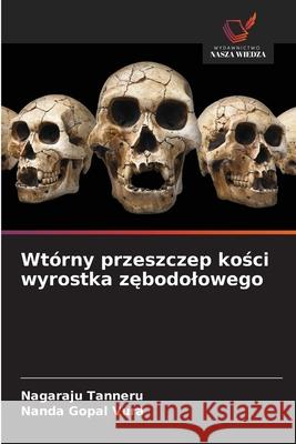 Wtórny przeszczep kosci wyrostka zebodolowego Tanneru, Nagaraju, Vura, Nanda Gopal 9786208724917 Wydawnictwo Nasza Wiedza
