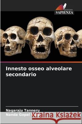 Innesto osseo alveolare secondario Tanneru, Nagaraju, Vura, Nanda Gopal 9786208724924 Edizioni Sapienza
