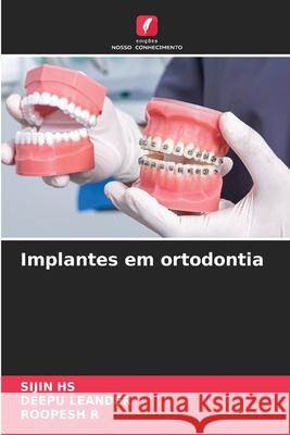 Implantes em ortodontia HS, SIJIN, LEANDER, DEEPU, R, ROOPESH 9786208758479 Edições Nosso Conhecimento
