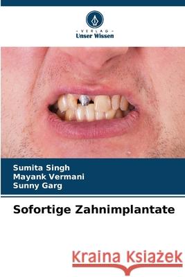 Sofortige Zahnimplantate Singh, Sumita, Vermani, Mayank, Garg, Sunny 9786208765101