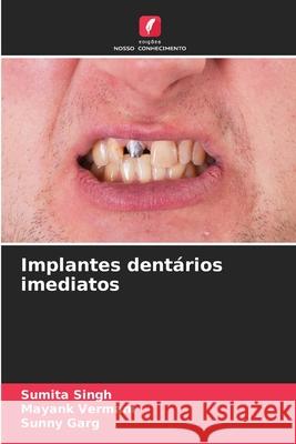 Implantes dentários imediatos Singh, Sumita, Vermani, Mayank, Garg, Sunny 9786208765149