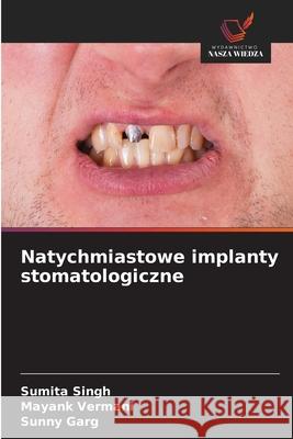 Natychmiastowe implanty stomatologiczne Singh, Sumita, Vermani, Mayank, Garg, Sunny 9786208765156