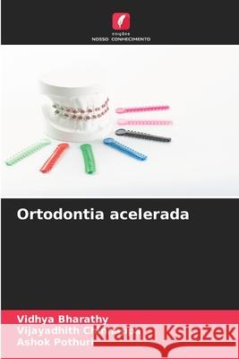Ortodontia acelerada Bharathy, Vidhya, Chinnappa, Vijayadhith, POTHURI, ASHOK 9786208856045 Edições Nosso Conhecimento