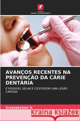 AVANÇOS RECENTES NA PREVENÇÃO DA CÁRIE DENTÁRIA V., Sreelakshmi 9786208862060 Edições Nosso Conhecimento