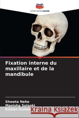 Fixation interne du maxillaire et de la mandibule Nehe, Shweta, Solanki, Manisha, Kumar, Kishan 9786208867195