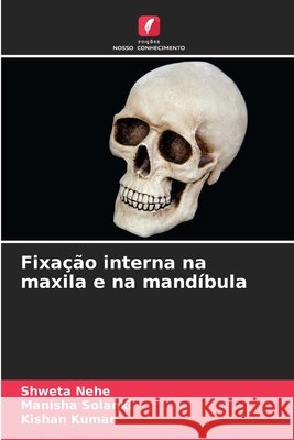Fixação interna na maxila e na mandíbula Nehe, Shweta, Solanki, Manisha, Kumar, Kishan 9786208867249