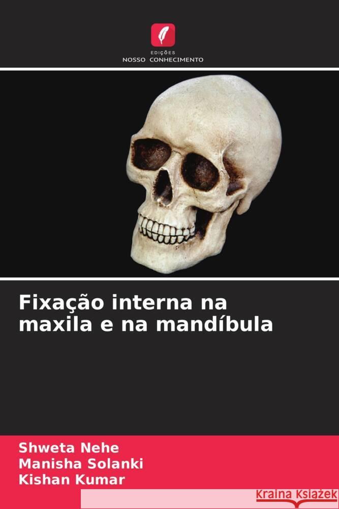 Fixação interna na maxila e na mandíbula Nehe, Shweta, Solanki, Manisha, Kumar, Kishan 9786208867249