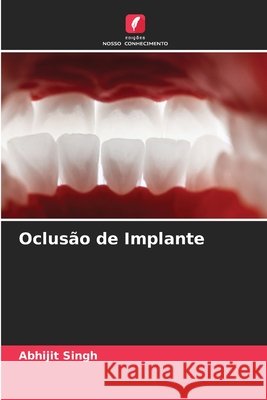 Oclusão de Implante Singh, Abhijit 9786208885120