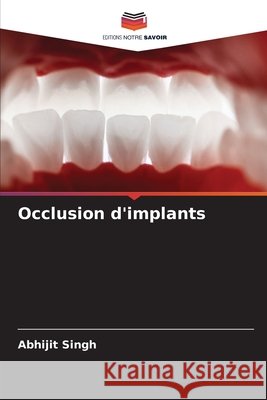 Occlusion d'implants Singh, Abhijit 9786208898069