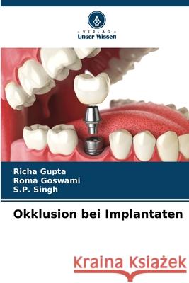 Okklusion bei Implantaten Gupta, Richa, Goswami, Roma, Singh, S. P. 9786208934620