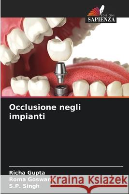 Occlusione negli impianti Gupta, Richa, Goswami, Roma, Singh, S. P. 9786208934651