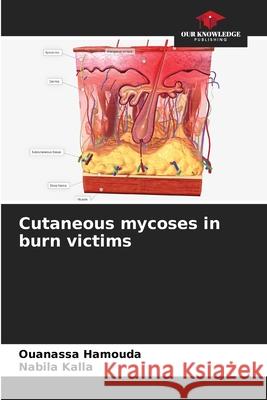 Cutaneous mycoses in burn victims Hamouda, Ouanassa, Kalla, Nabila 9786208944223