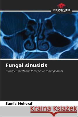Fungal sinusitis Meherzi, Samia 9786208954451