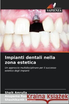 Impianti dentali nella zona estetica Amrulla, Shaik, Rao, Anupama, Hegde, Shashikanth 9786209088254