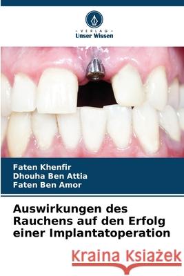 Auswirkungen des Rauchens auf den Erfolg einer Implantatoperation Khenfir, Faten, Ben Attia, Dhouha, Ben Amor, Faten 9786209125768 Verlag Unser Wissen