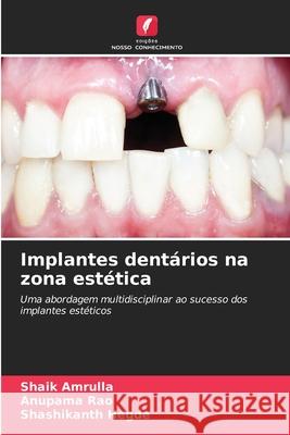 Implantes dentários na zona estética Amrulla, Shaik, Rao, Anupama, Hegde, Shashikanth 9786209128875