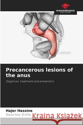 Precancerous lesions of the anus Hassine, Hajer, Krifa, Nesrine 9786209139147 Our Knowledge Publishing