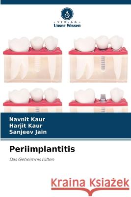 Periimplantitis Kaur, Navnit, Kaur, Harjit, Jain, Sanjeev 9786209325212