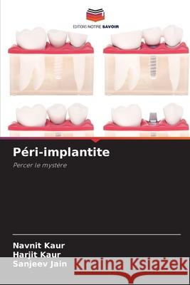 Péri-implantite Kaur, Navnit, Kaur, Harjit, Jain, Sanjeev 9786209330339