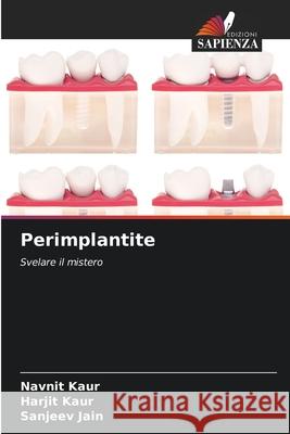 Perimplantite Kaur, Navnit, Kaur, Harjit, Jain, Sanjeev 9786209332890