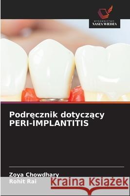 Podrecznik dotyczacy PERI-IMPLANTITIS Chowdhary, Zoya, Rai, Rohit 9786209335969