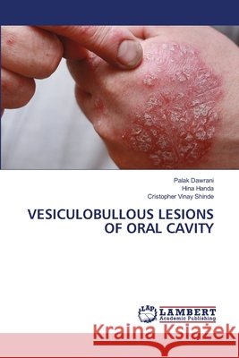VESICULOBULLOUS LESIONS OF ORAL CAVITY Dawrani, Palak, Handa, Hina, Shinde, Cristopher Vinay 9786209420504