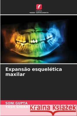 Expansão esquelética maxilar Gupta, Soni, Shekatkar, Yash 9786209726033