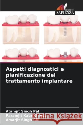 Aspetti diagnostici e pianificazione del trattamento implantare Pal, Atamjit Singh, Khinda, Paramjit Kaur, Gill, Amarjit Singh 9786209849206